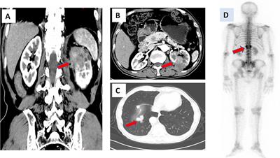 Persistent Response to a Combination Treatment Featuring a Targeted Agent and an Immune Checkpoint Inhibitor in a Patient With Collecting Duct Renal Carcinoma: A Case Report and Literature Review